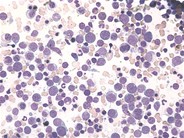 Acute-erythroid-leukemia--1