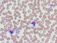 Pseudothrombocytopenia - 1.