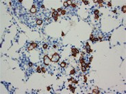 Plasma cell myeloma - Russell bodies