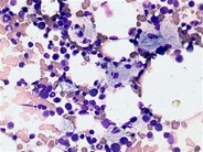 Gaucher’s disease: aspirate - 1.