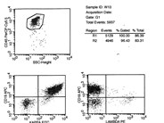 Mantle cell lymphoma - CSF