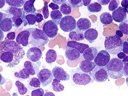 Acute myelomonocytic leukemia - 3.