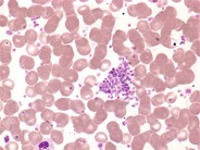 Essential thrombocythemia