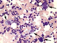 Anaplastic large cell lymphoma - bone marrow aspirate - 1.