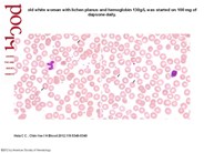 Dapsone hemolysis