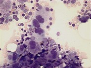 AML with inv(3) - 3.