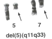 Myeloid Neoplasms. Myelodysplastic Syndrome: Refractory Ctyopenia with Multilineage Dysplasia - 10.