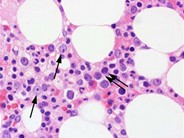 Myeloid Neoplasms. Myelodysplastic Syndrome: Refractory Ctyopenia with Multilineage Dysplasia - 3.