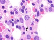 Myeloid Neoplasms. Myelodysplastic Syndrome: Refractory Ctyopenia with Multilineage Dysplasia - 5.