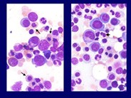 Myeloid Neoplasms. Myelodysplastic Syndrome: Refractory Ctyopenia with Multilineage Dysplasia - 6.