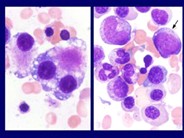Myeloid Neoplasms. Myelodysplastic Syndrome: Refractory Ctyopenia with Multilineage Dysplasia - 7.