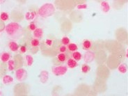 Myeloid Neoplasms. Myelodysplastic Syndrome: Refractory Ctyopenia with Multilineage Dysplasia - 8.