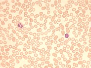 Pure Red Cell Aplasia (PRCA) –  parvovirus infection - 1.