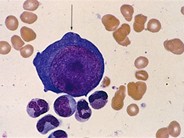 Pure Red Cell Aplasia (PRCA) –  parvovirus infection - 3.