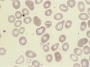 Red Blood Cell Diseases (RBC) 1 - 3.