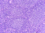 Follicular Lymphoma, Grade 1/3 - 2.