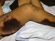 Postvaricella purpura fulminans - 1.