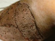 Postvaricella purpura fulminans - 3.