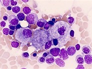 Gaucher's Disease - 1(b).