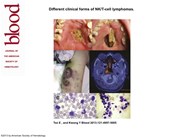 Different clinical forms of NK/T-cell lymphomas