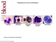 Congenital dyserythropoietic anemias