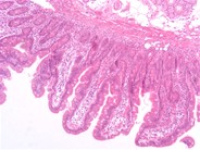 Enteropathy Type T Cell Lymphoma - 3.