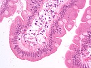 Enteropathy Type T Cell Lymphoma - 4.