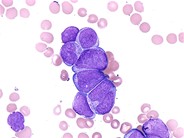 Blast-Crisis-of-CML--4