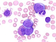 Blast-Crisis-of-CML--5