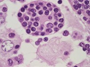 Sinus histiocytosis with massive lymphadenopathy (Rosai-Dorfman Disease) - 3.