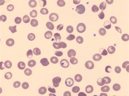 Hemoglobin S blister cell variant