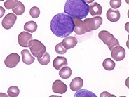 Acute Myelomonocytic Leukemia - 2.