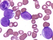 Acute Myelomonocytic Leukemia - 3.