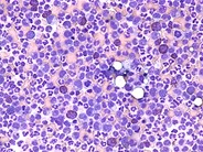 Chronic-Phase-CML--1