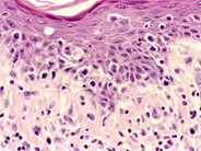 Mycosis Fungoides - 2.