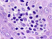 Mycosis Fungoides - 3.