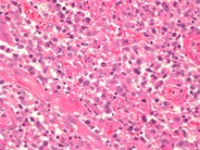 Primary Cutaneous Anaplastic Large Cell Lymphoma - 2.