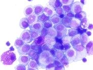 Pleural Fluid Mast Cells - 4.