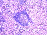 Sinus histiocytosis with massive lymphadenopathy - 2.