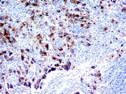 Sinus histiocytosis with massive lymphadenopathy - 5.