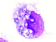 Histoplasmosis - 2.