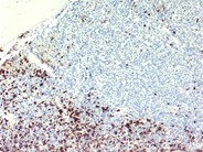 Recurrent AML following peripheral stem cell transplant - 7.