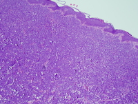 Myeloid-sarcoma