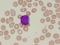 Acute myeloid leukemia with myelodysplasia related changes