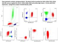 ALL Ph+ CD 13 positive flow cytometry