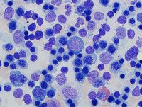 Congenital-sideroblastic-anemia-aspirate