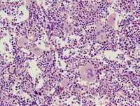 Essential-thrombocythemia
