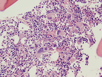 Essential-thrombocythemia