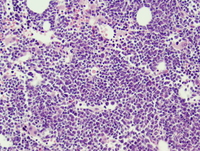 AML-with-inv3q21q262-Biopsy-low-power