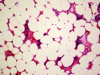 Dyskeratosis-Congenita